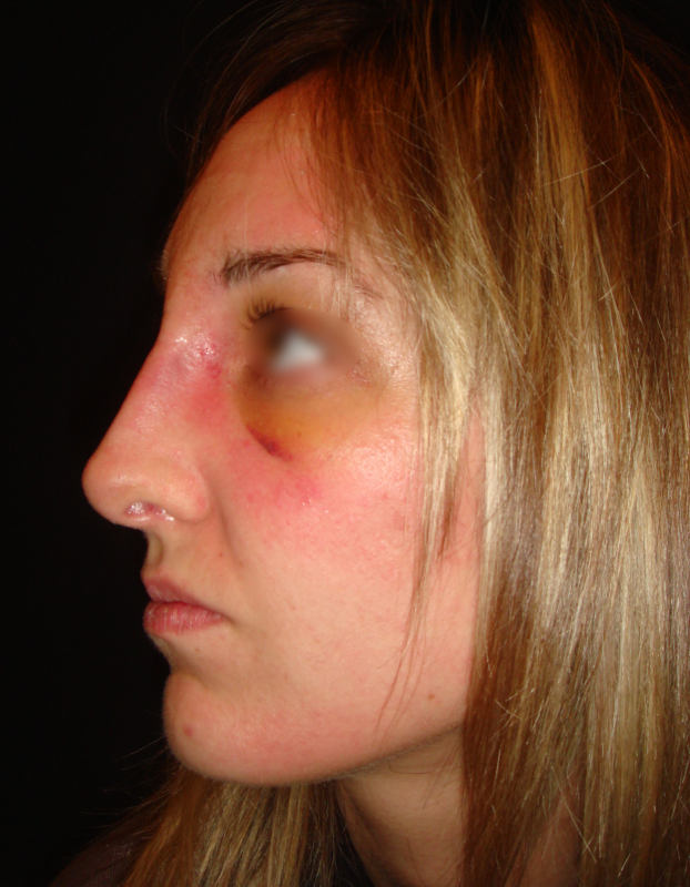 Suivi et évolution d’une rhinoplastie